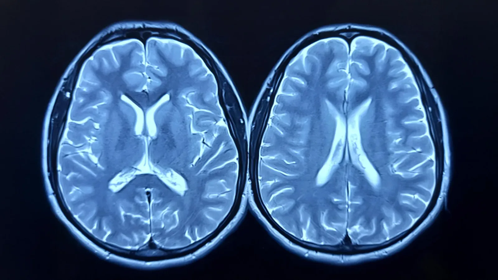 Pandemic Stress Aged Brains Even Without COVID Infection